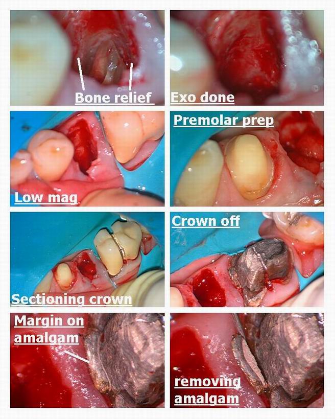 Resize of Resize of Osseous recontouring with bridge pt 2.jpg